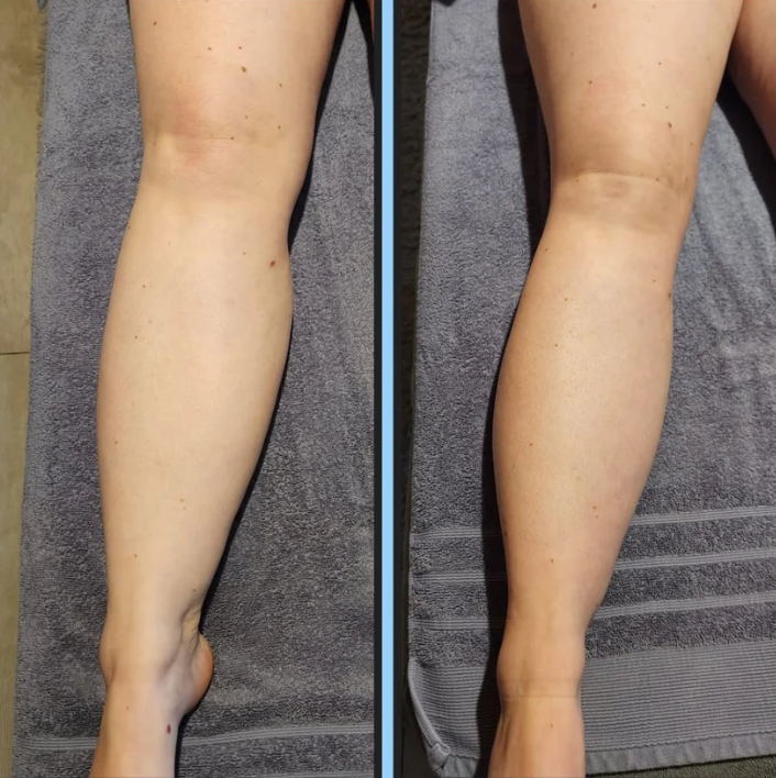 Liquid Lymphatic Drainage