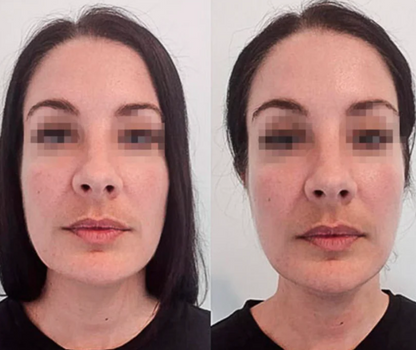 Liquid Lymphatic Drainage